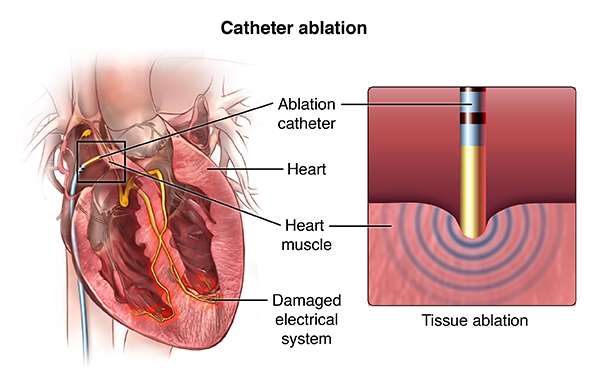 Radiofrequency Ablation: What is it, Procedure, Recovery.
